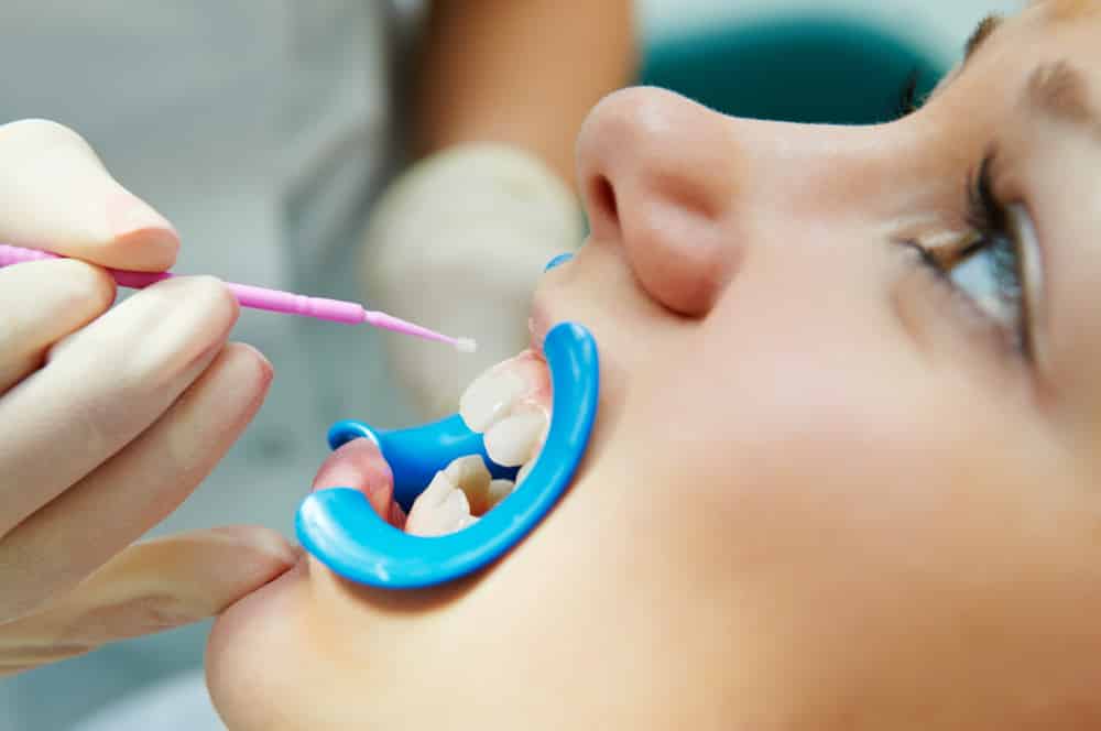 Dental Sealants | FAQs Answered By Dr. Kaur