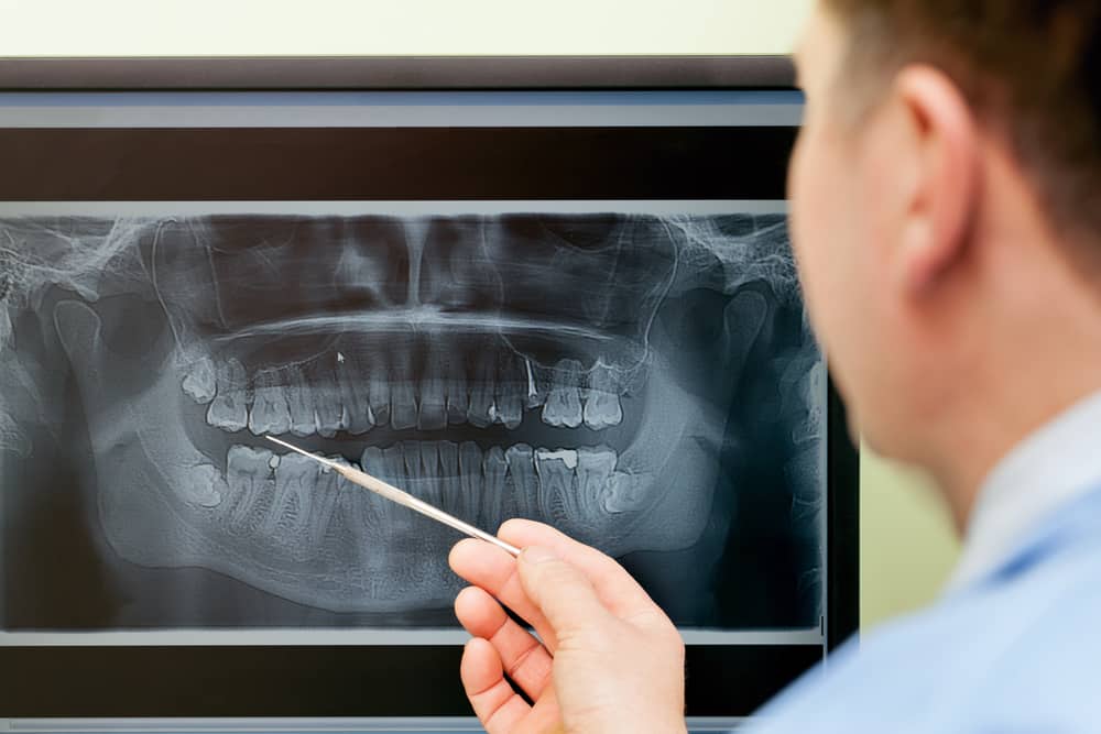Digital Dental X-Rays | FAQs Answered By Dr. Kaur
