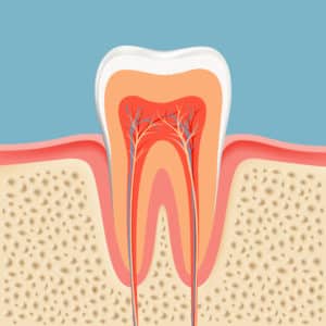 root canal treatment