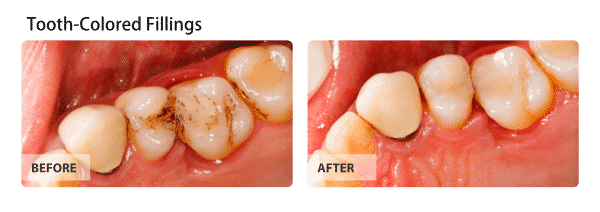 Tooth-Colored Fillings