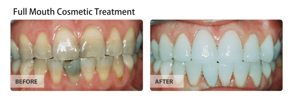 Full mouth cosmetic treatment