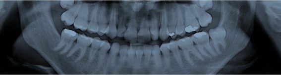 Dental X-rays