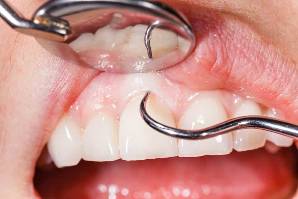 Arestin To Treat Gum Disease | Dental Designer, NJ