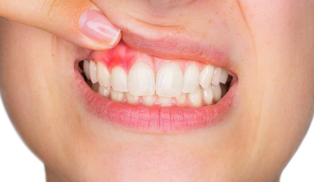 How Do I Know If I Have Gum Disease? | Dental Designer, NJ