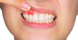 Periodontitis Disease Treatment