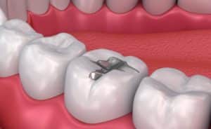 amalgam dental fillings