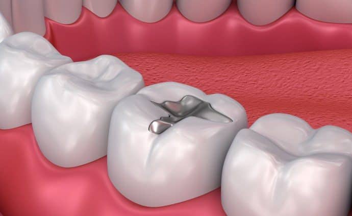 Should I replace Amalgam Fillings?