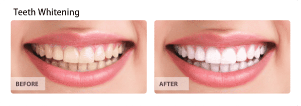 Teeth Whitening