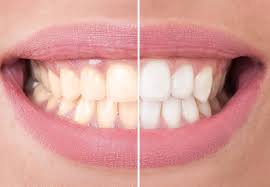 teeth whitening before after results