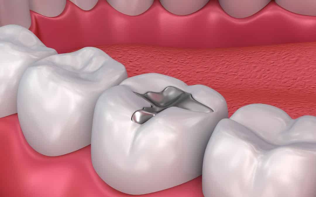 ¡Los empastes dentales también pueden parecerse a los dientes naturales!