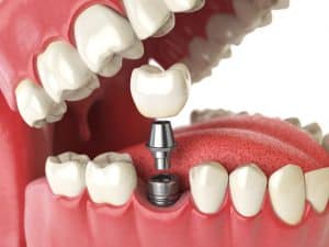 Dental crowns and bridges