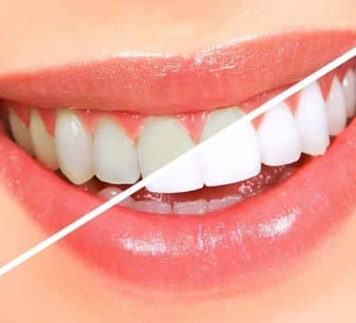 Teeth whitening