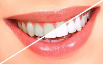 Regain Your Dazzling Smile With Teeth Whitening!